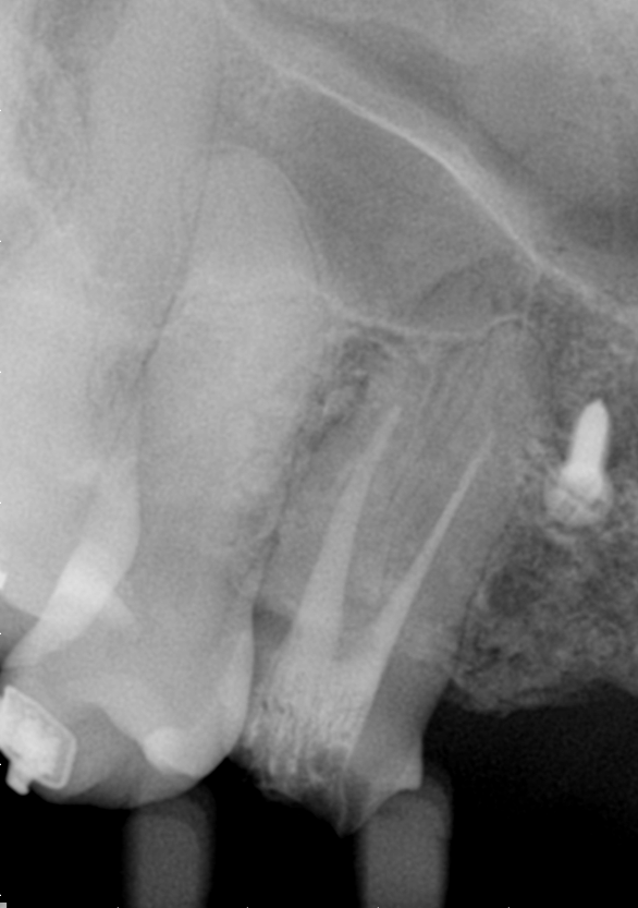 Radiografia inicial do caso