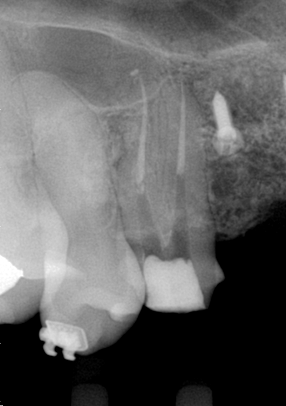 Radiografia final do caso