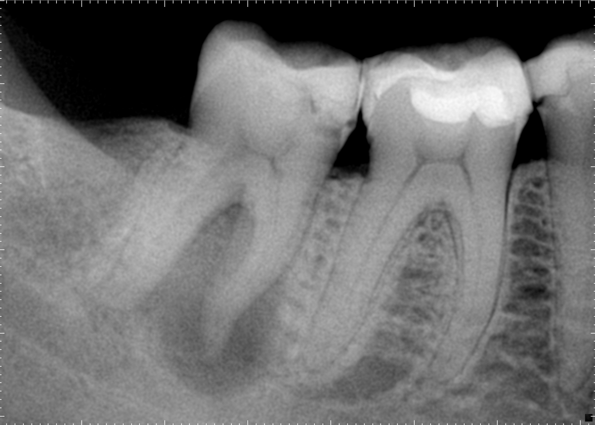 Radiografia inicial do caso