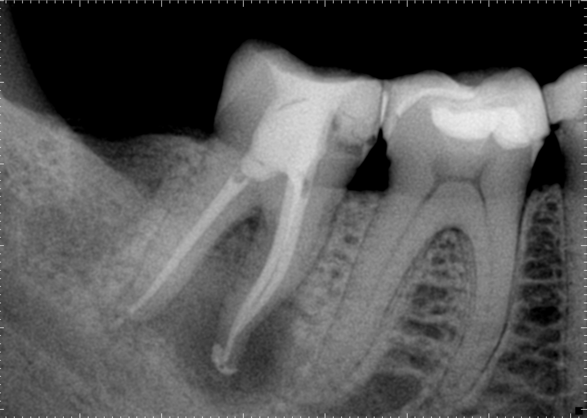 Radiografia final do caso