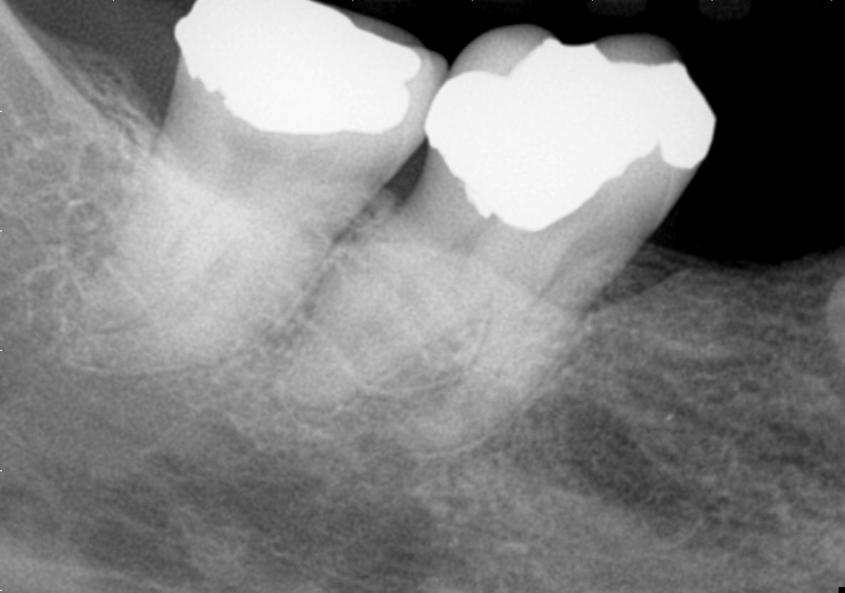 Radiografia inicial do caso