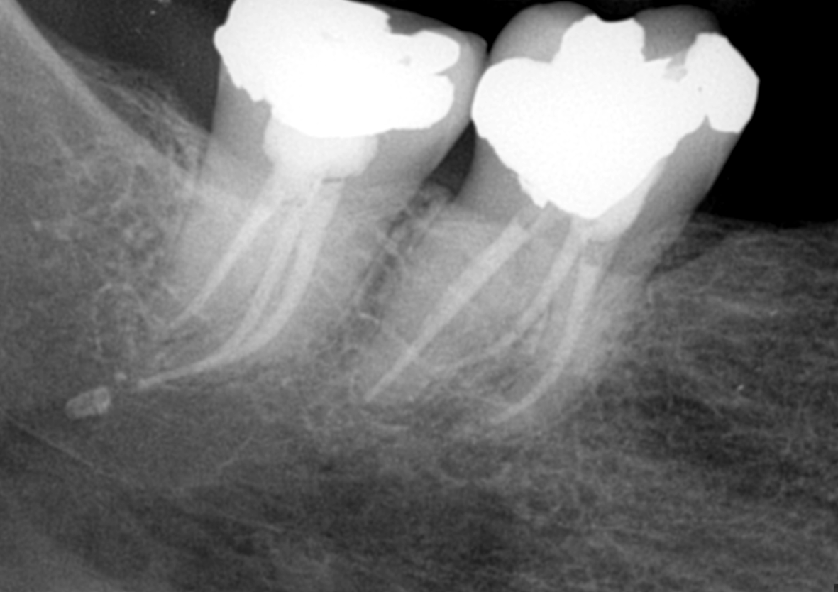 Radiografia final do caso